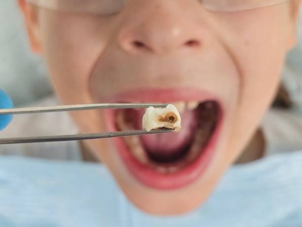 Best Emergency Treatment for Dental Infections or Abscesses in Lake Jackson, TX